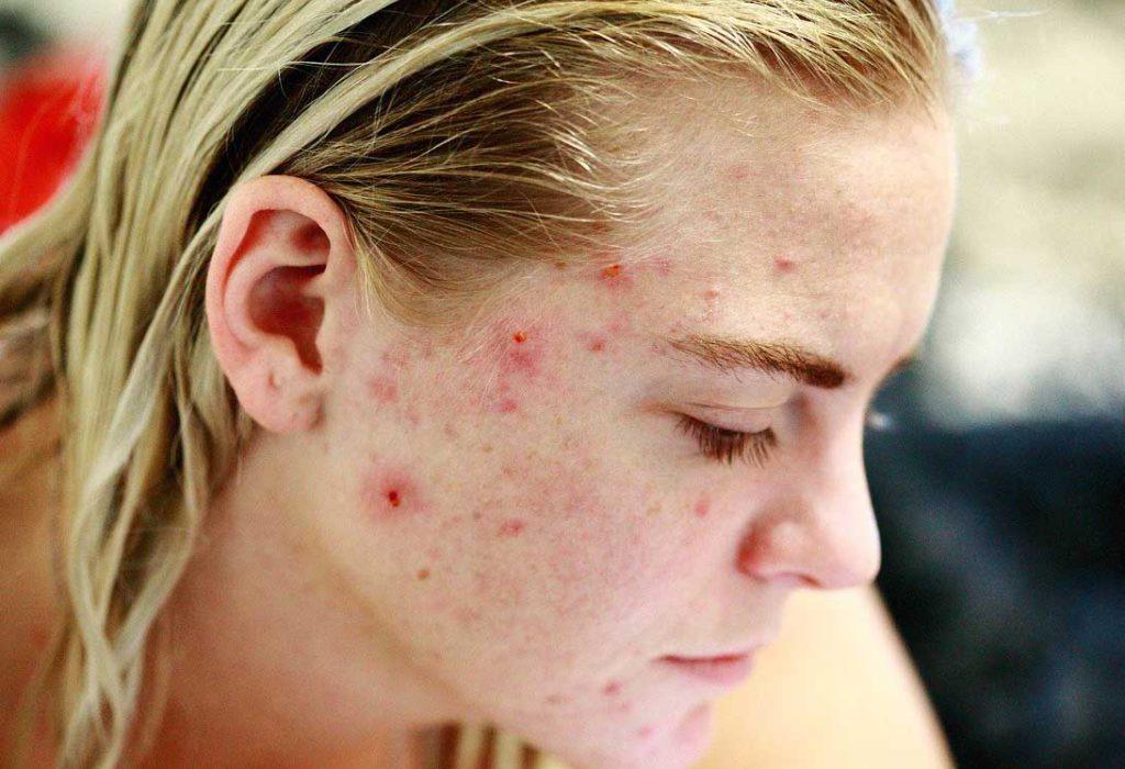 All You Need to Know on How To Clear Acne Scars For Good