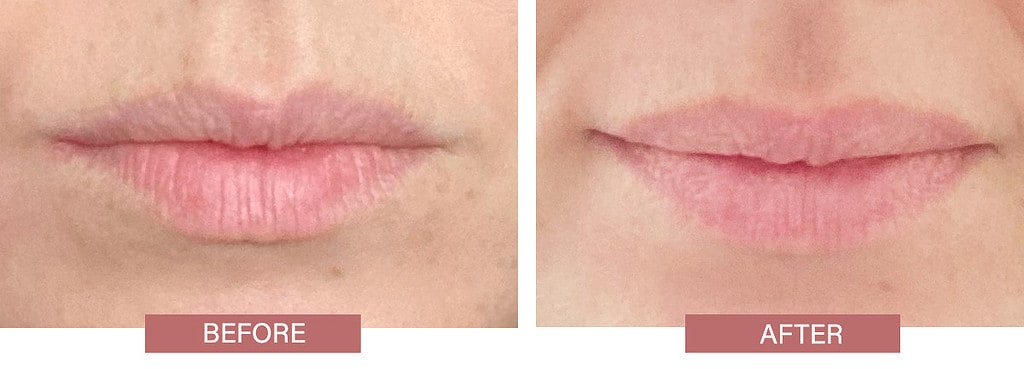 City Lips Before and After